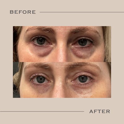 Lower Blepharoplasty Before & After Gallery - Patient 266976 - Image 1