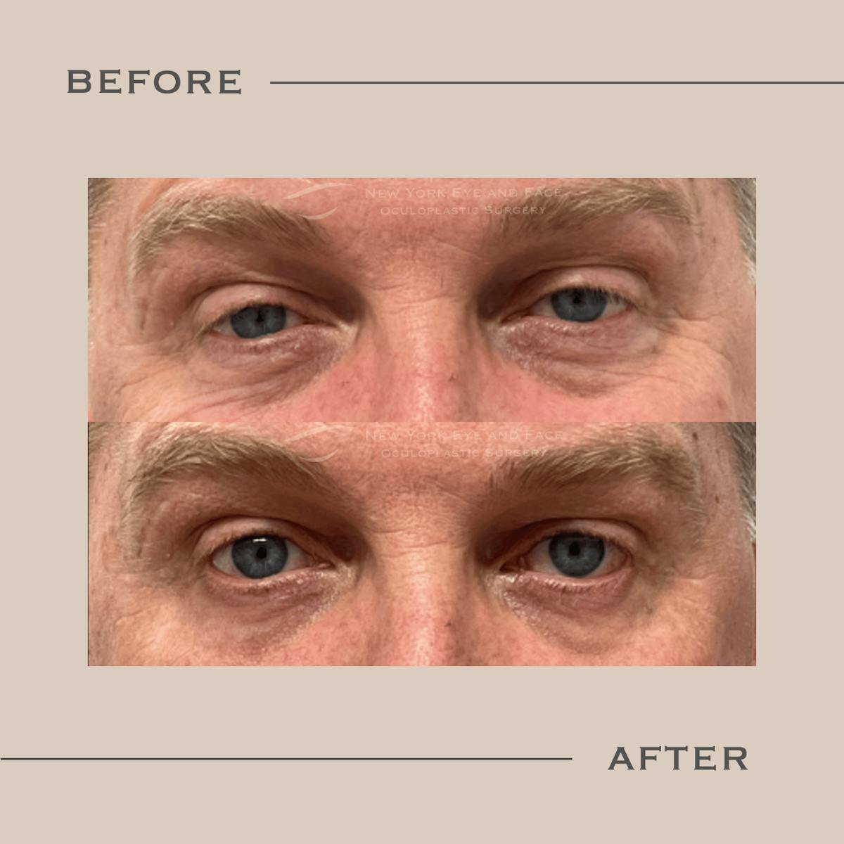 Male Blepharoplasty Before & After Gallery - Patient 325639 - Image 1