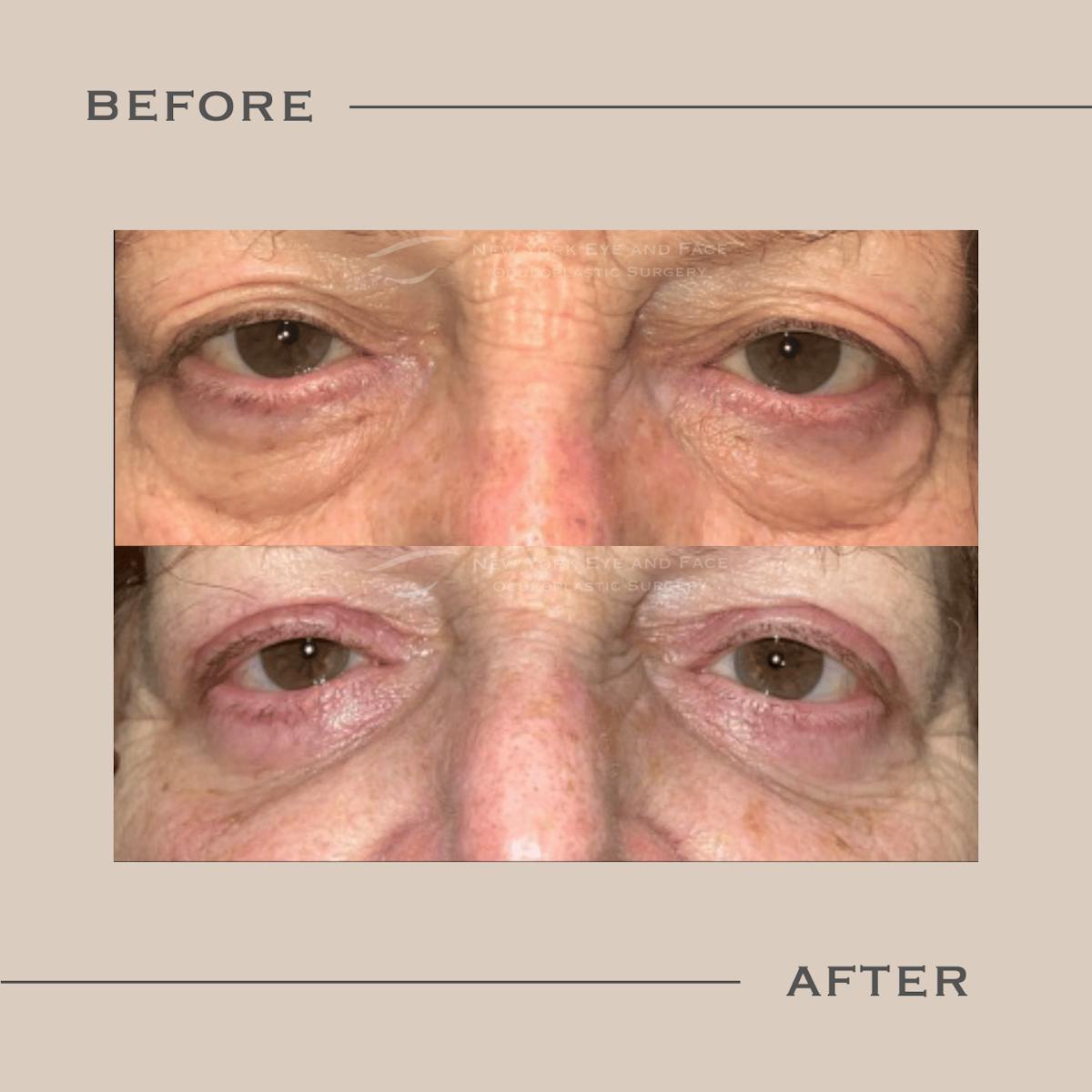 Lower Blepharoplasty Before & After Gallery - Patient 817483 - Image 1