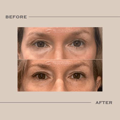 Lower Blepharoplasty Before & After Gallery - Patient 222464 - Image 1