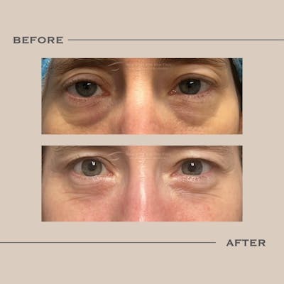 Lower Blepharoplasty Before & After Gallery - Patient 408550 - Image 1