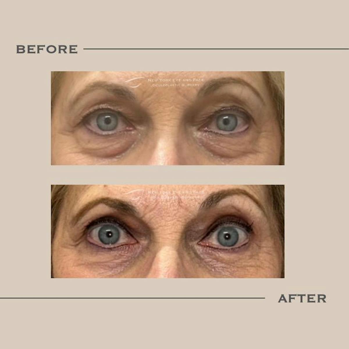 Lower Blepharoplasty Before & After Gallery - Patient 258535 - Image 1