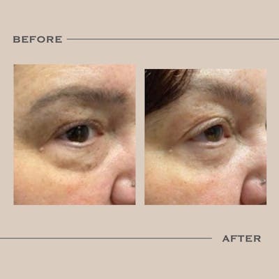 Lower Blepharoplasty Before & After Gallery - Patient 310038 - Image 1