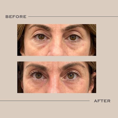 Lower Blepharoplasty Before & After Gallery - Patient 317305 - Image 1