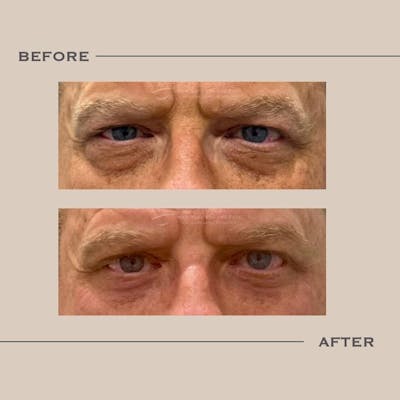Lower Blepharoplasty Before & After Gallery - Patient 396692 - Image 1