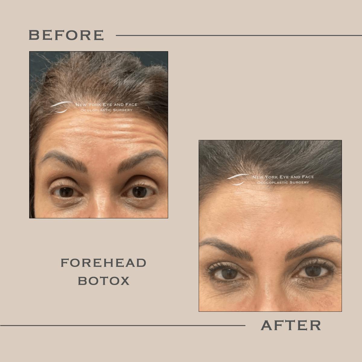 BOTOX Before & After Gallery - Patient 880522 - Image 1