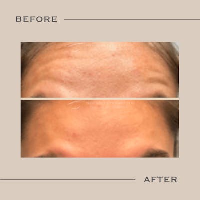 BOTOX Before & After Gallery - Patient 299532 - Image 1