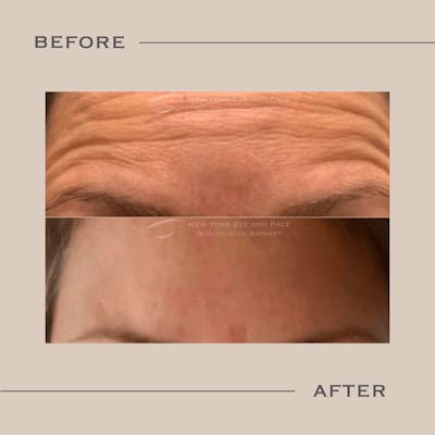 BOTOX Before & After Gallery - Patient 362102 - Image 1