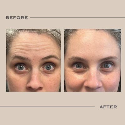 BOTOX Before & After Gallery - Patient 345376 - Image 1