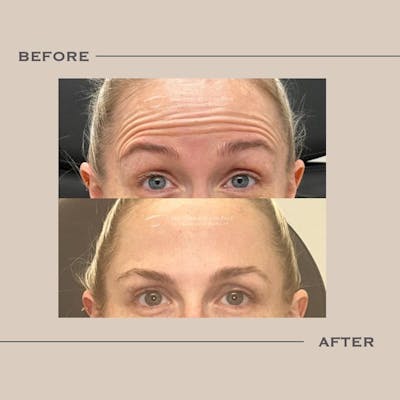BOTOX Before & After Gallery - Patient 113751 - Image 1
