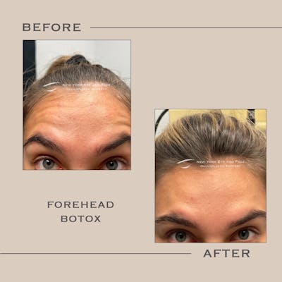 BOTOX Before & After Gallery - Patient 685839 - Image 1