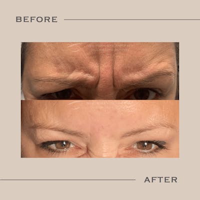 BOTOX Before & After Gallery - Patient 277242 - Image 1