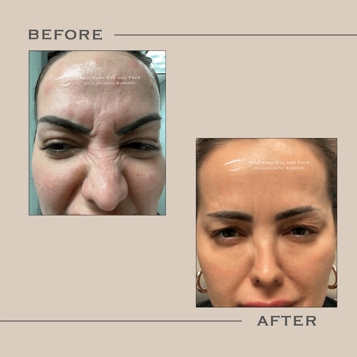 BOTOX Before & After Gallery - Patient 189250 - Image 1