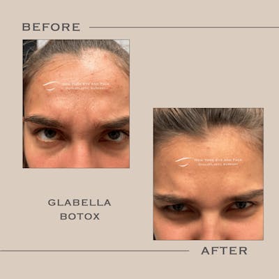 BOTOX Before & After Gallery - Patient 408424 - Image 1