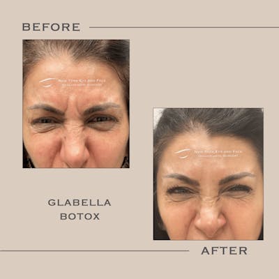 BOTOX Before & After Gallery - Patient 112413 - Image 1