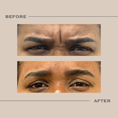 BOTOX Before & After Gallery - Patient 165580 - Image 1