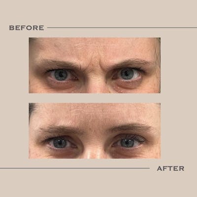 BOTOX Before & After Gallery - Patient 215779 - Image 1