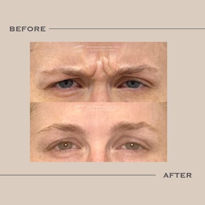 BOTOX Before & After Gallery - Patient 274073 - Image 1