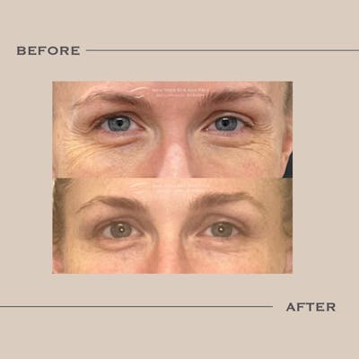 BOTOX Before & After Gallery - Patient 329558 - Image 1