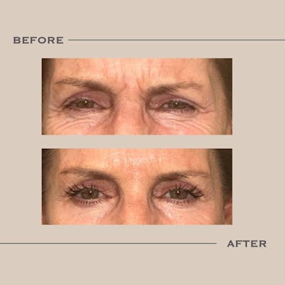 BOTOX Before & After Gallery - Patient 332388 - Image 1