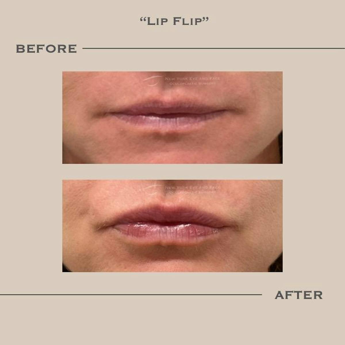 BOTOX Before & After Gallery - Patient 145896 - Image 1