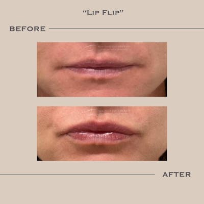 BOTOX Before & After Gallery - Patient 145896 - Image 1