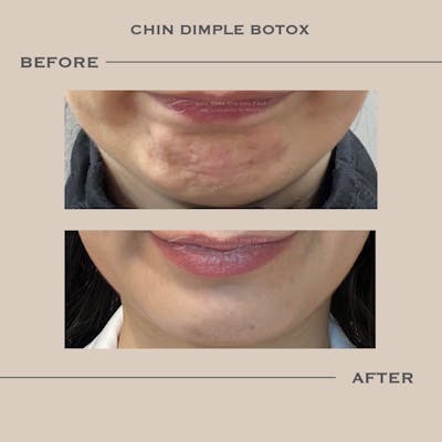 BOTOX Before & After Gallery - Patient 364848 - Image 1