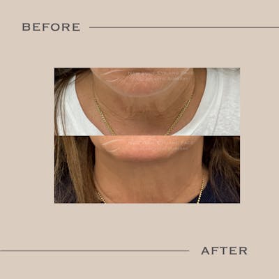 BOTOX Before & After Gallery - Patient 357486 - Image 1