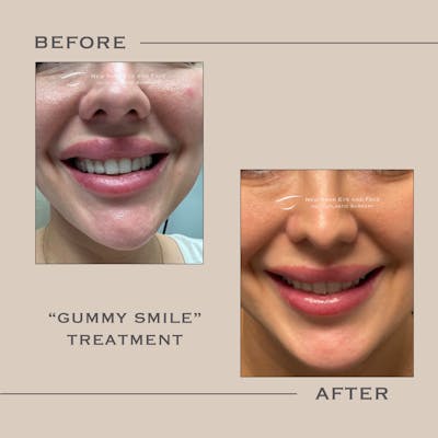 BOTOX Before & After Gallery - Patient 224162 - Image 1