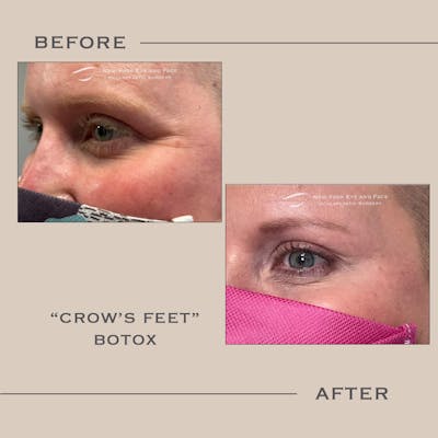 BOTOX Before & After Gallery - Patient 258121 - Image 1