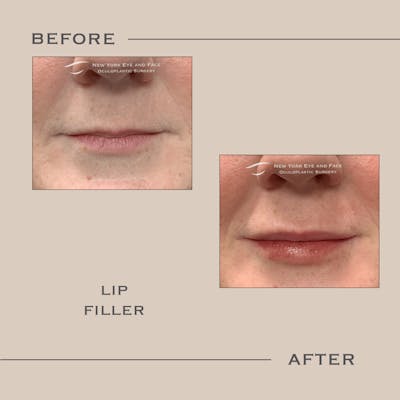 Dermal Fillers Before & After Gallery - Patient 200733 - Image 1