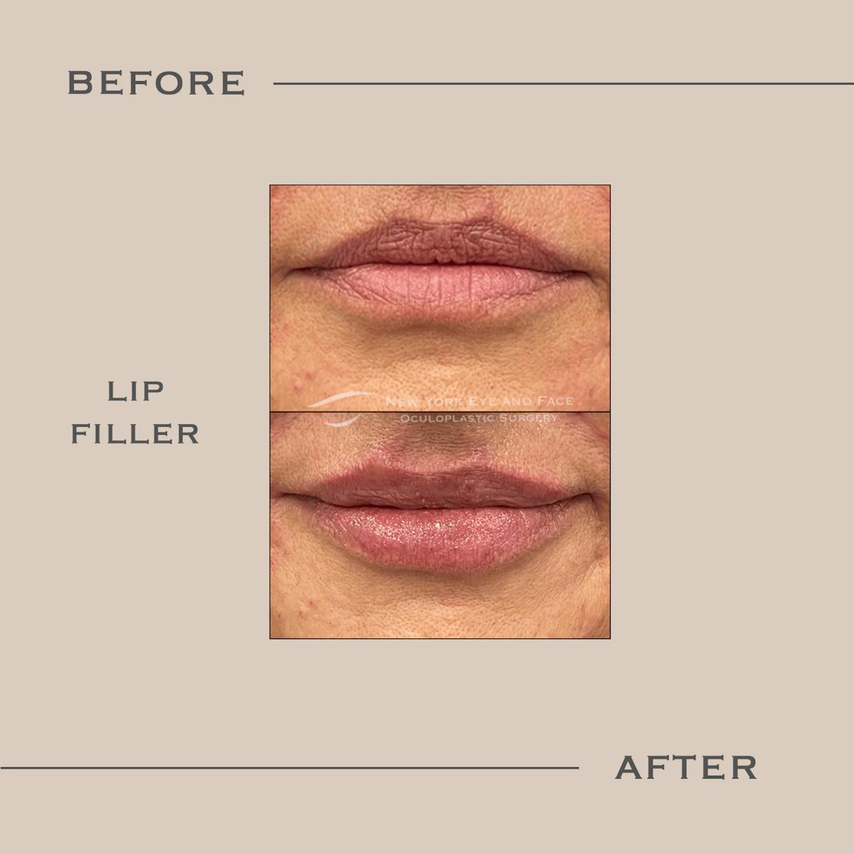 Dermal Fillers Before & After Gallery - Patient 300029 - Image 1