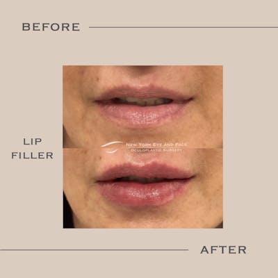 Dermal Fillers Before & After Gallery - Patient 277847 - Image 1