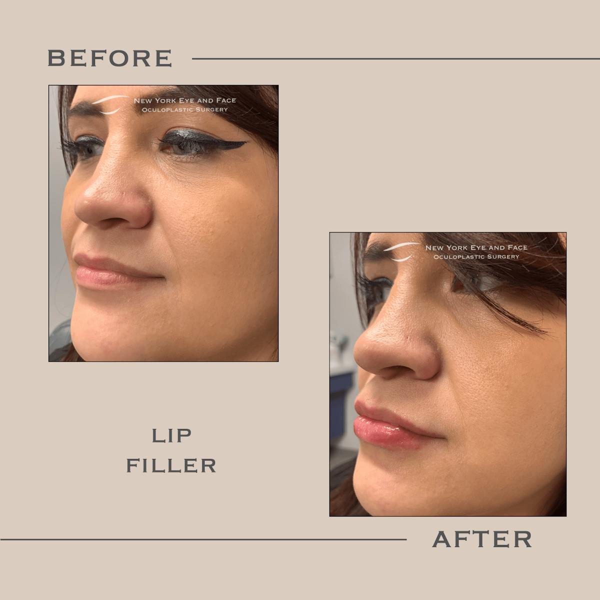 Dermal Fillers Before & After Gallery - Patient 986136 - Image 1