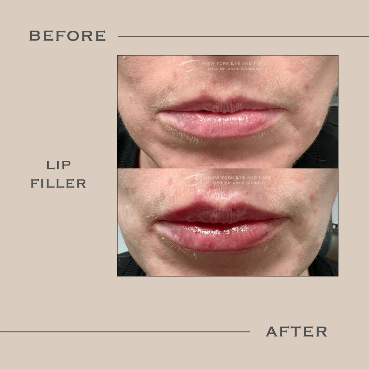 Dermal Fillers Before & After Gallery - Patient 324827 - Image 1