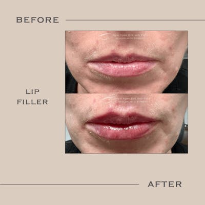 Dermal Fillers Before & After Gallery - Patient 324827 - Image 1