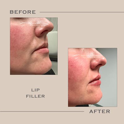 Dermal Fillers Before & After Gallery - Patient 317991 - Image 1