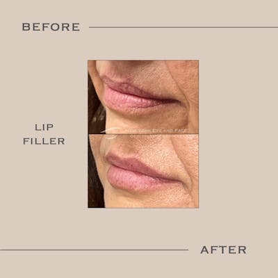 Dermal Fillers Before & After Gallery - Patient 138837 - Image 1