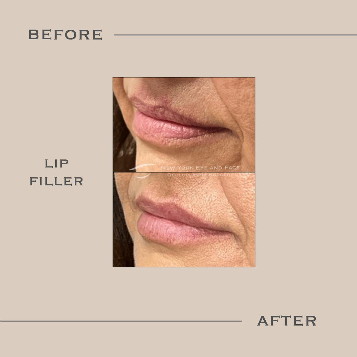 Lip Fillers Before & After Gallery - Patient 100317 - Image 1