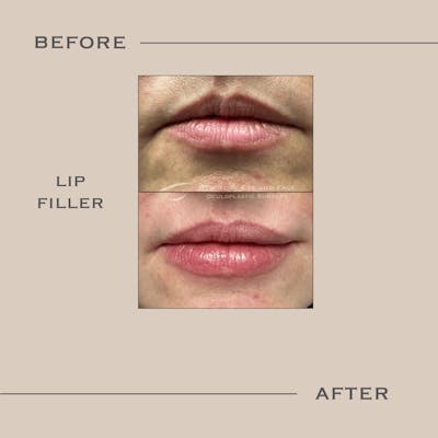 Dermal Fillers Before & After Gallery - Patient 771619 - Image 1