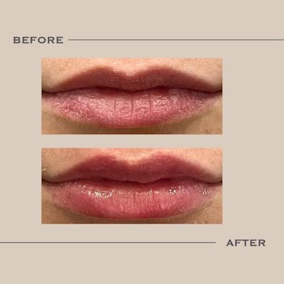 Lip Fillers Before & After Gallery - Patient 271012 - Image 1