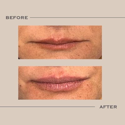 Lip Fillers Before & After Gallery - Patient 296014 - Image 1