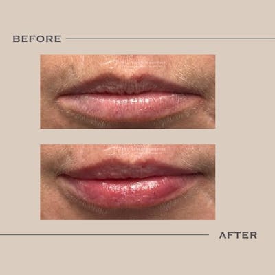 Lip Fillers Before & After Gallery - Patient 367587 - Image 1