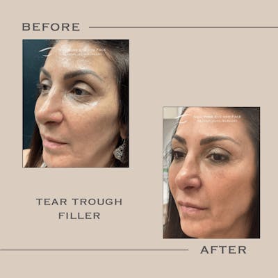Dermal Fillers Before & After Gallery - Patient 367788 - Image 1