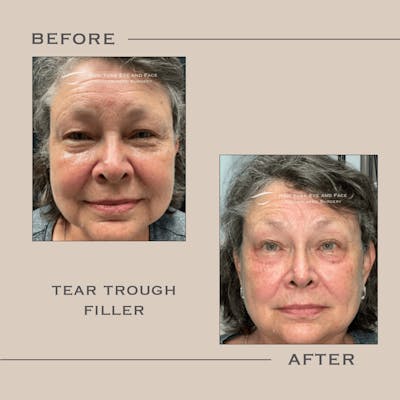 Dermal Fillers Before & After Gallery - Patient 424696 - Image 1