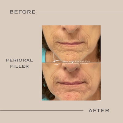 Dermal Fillers Before & After Gallery - Patient 367078 - Image 1