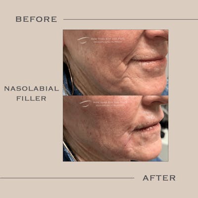 Dermal Fillers Before & After Gallery - Patient 202630 - Image 1