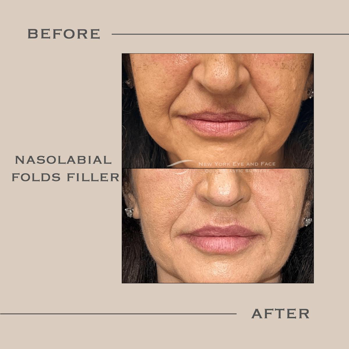 Dermal Fillers Before & After Gallery - Patient 285810 - Image 1