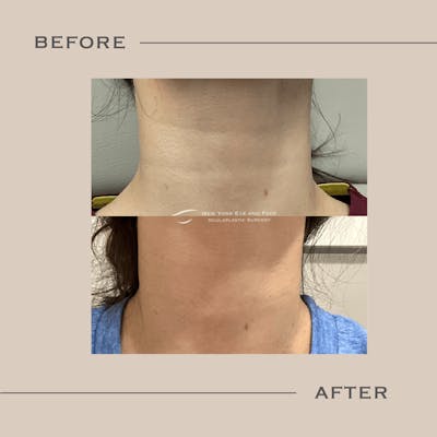 Dermal Fillers Before & After Gallery - Patient 162580 - Image 1