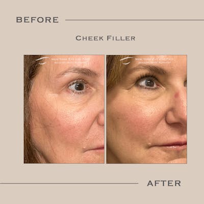 Dermal Fillers Before & After Gallery - Patient 127420 - Image 1